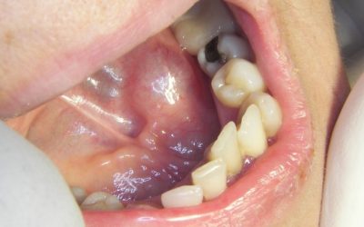 ΠΑΘΗΣΕΙΣ ΣΙΑΛΟΓΟΝΩΝ ΑΔΕΝΩΝ